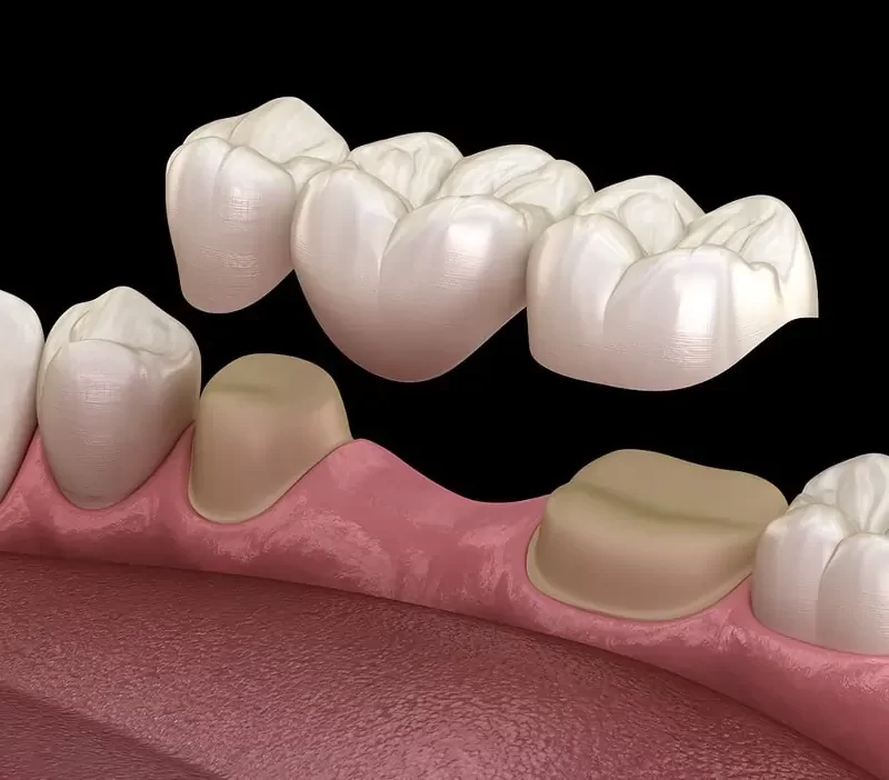 Dental Bridge