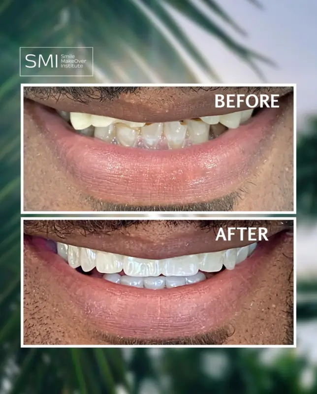 Smile Makeover offer | Veneers vs Crowns