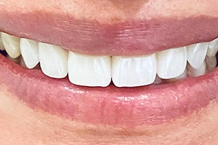 cosmetic dentist st pete | after